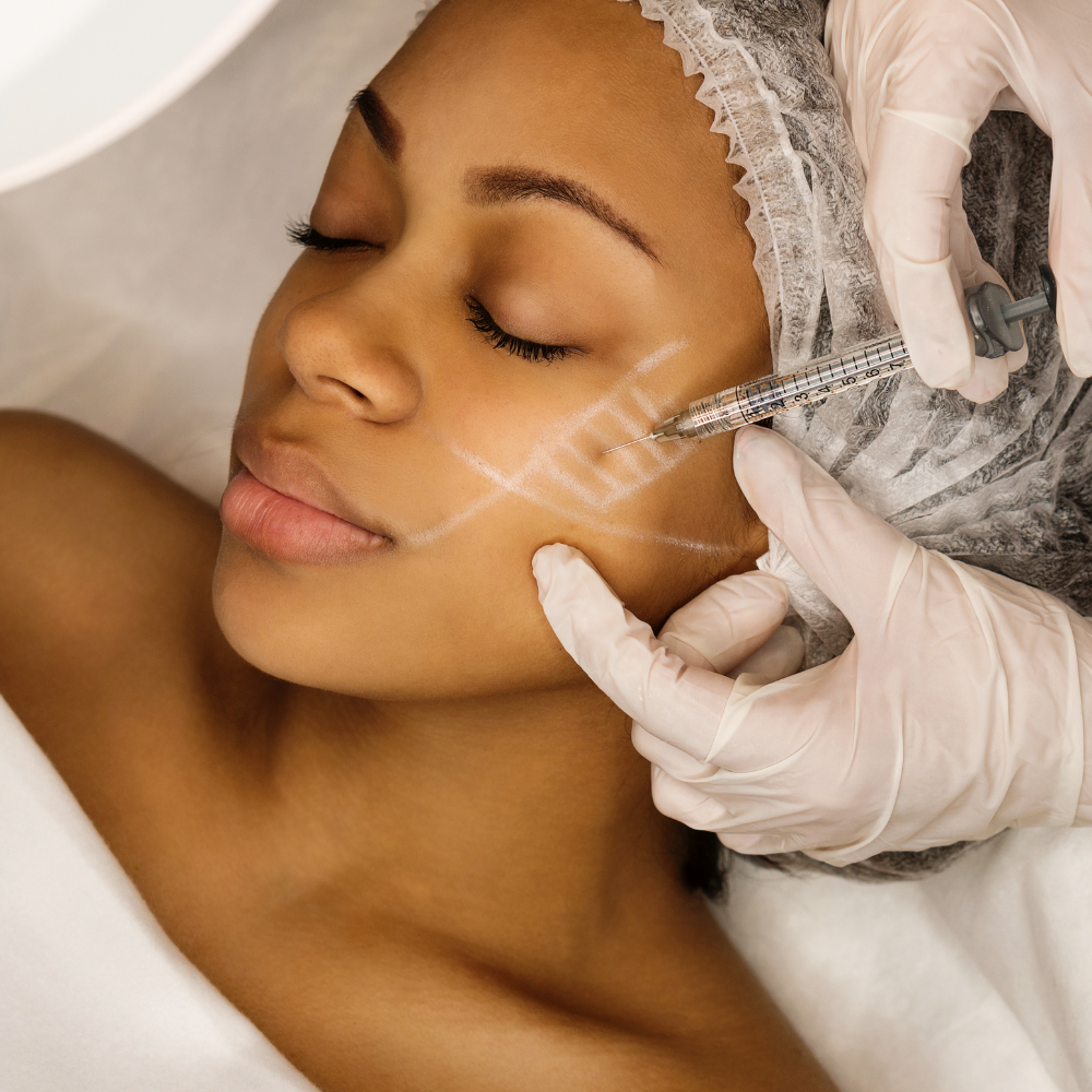 Cheek dermal filler treatment at Beauty Clinic By Ketty enhancing facial structure safely